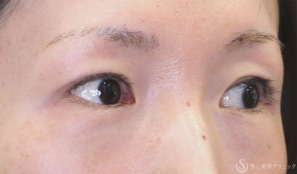 【30代女性・自然な二重に】  二重術（切開法）部分切開/全切開（3年後） After 