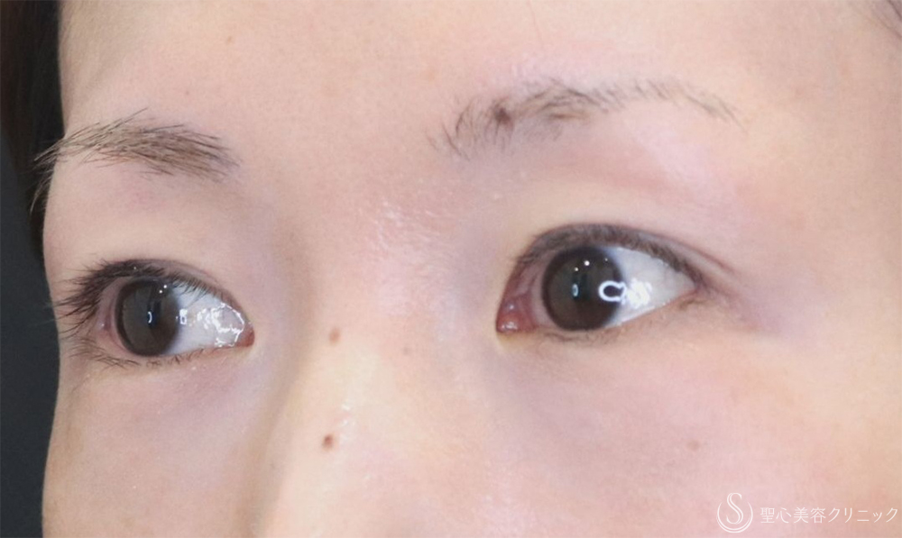 【30代女性・自然な二重に】  二重術（切開法）部分切開/全切開（3年後） After 