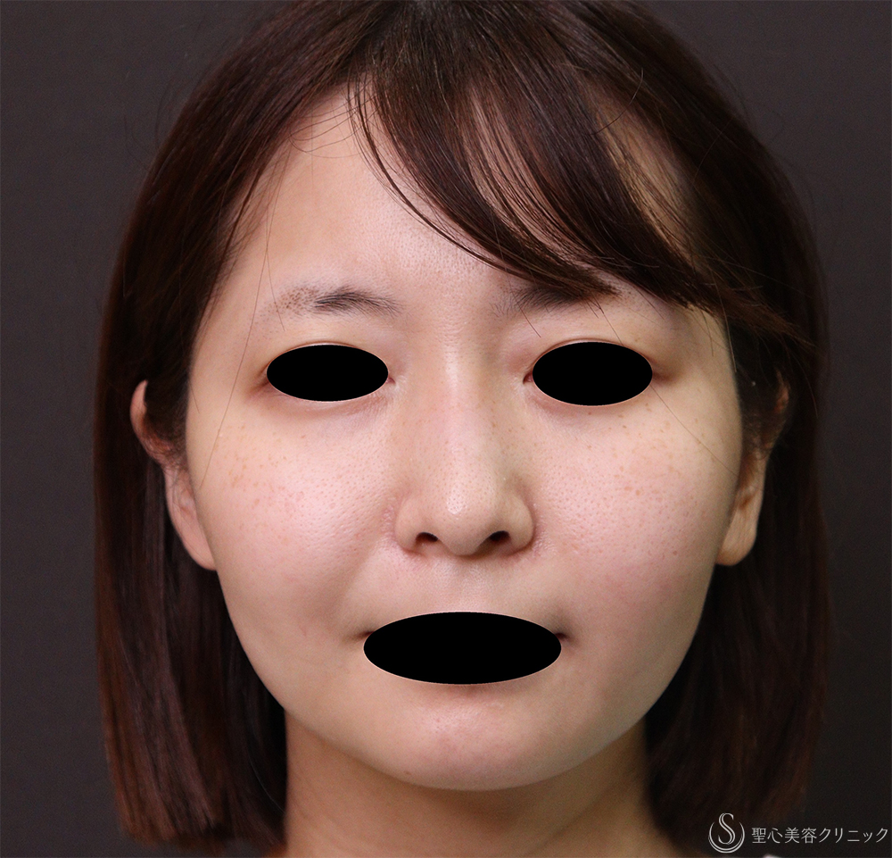 【20代女性・顔のボリューム】脂肪吸引注射（術後4ヶ月） Before 