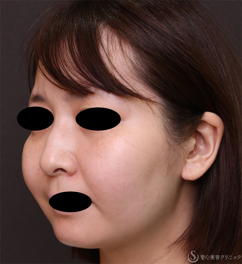 【20代女性・顔のボリューム】脂肪吸引注射（術後4ヶ月） Before 