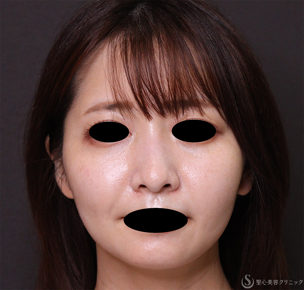【20代女性・顔のボリューム】脂肪吸引注射（術後4ヶ月） After 