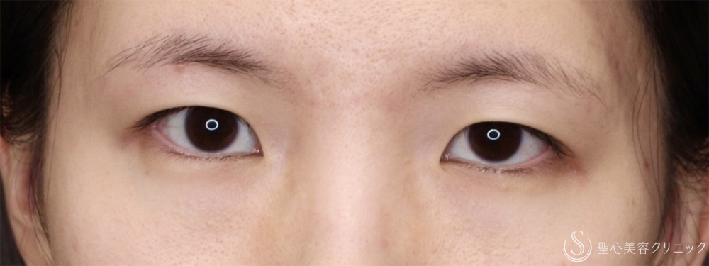 【20代女性・自然な変化で悩みを解消】 目頭切開/目上切開（1ヶ月後） Before 