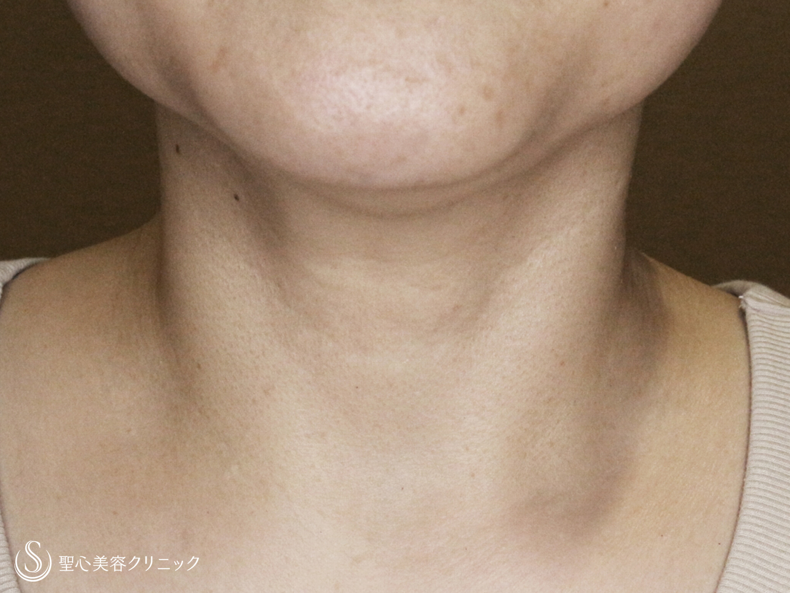 【40代女性・首の横ジワを綺麗に】プレミアムPRP皮膚再生療法（2年後） After 