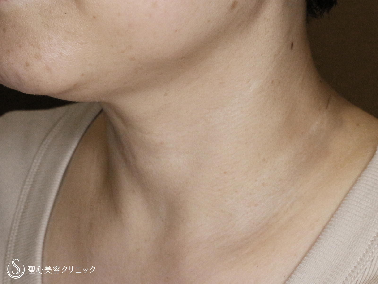 【40代女性・首の横ジワを綺麗に】プレミアムPRP皮膚再生療法（2年後） After 