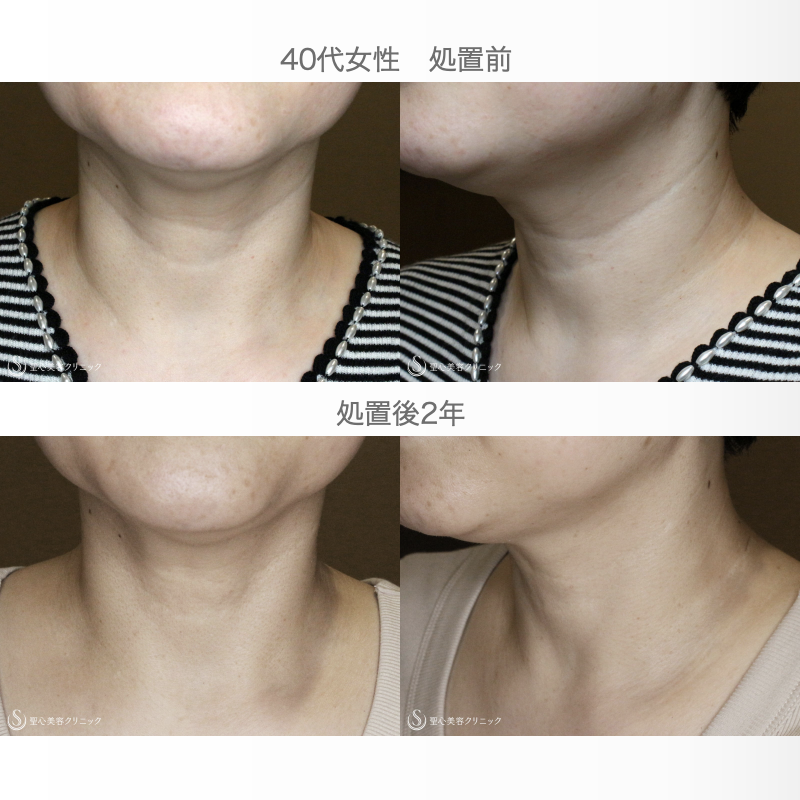 【40代女性・首の横ジワを綺麗に】プレミアムPRP皮膚再生療法（2年後） After 