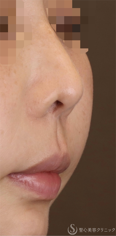 【30代女性・鼻の穴を目立ちにくくしたい！！】鼻孔縁下降術（1ヶ月後） Before 