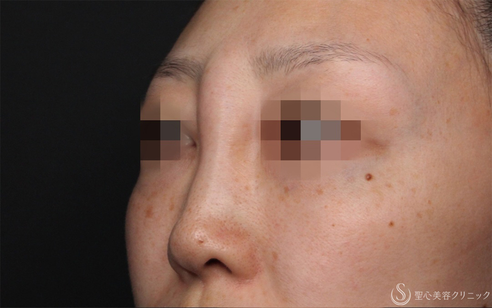 【30代女性・不自然な鼻根修正】鼻アクアミド除去（1ヶ月後） Before 