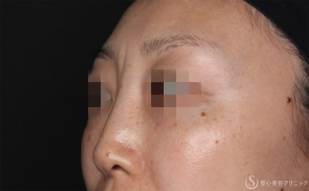 【30代女性・不自然な鼻根修正】鼻アクアミド除去（1ヶ月後） After 