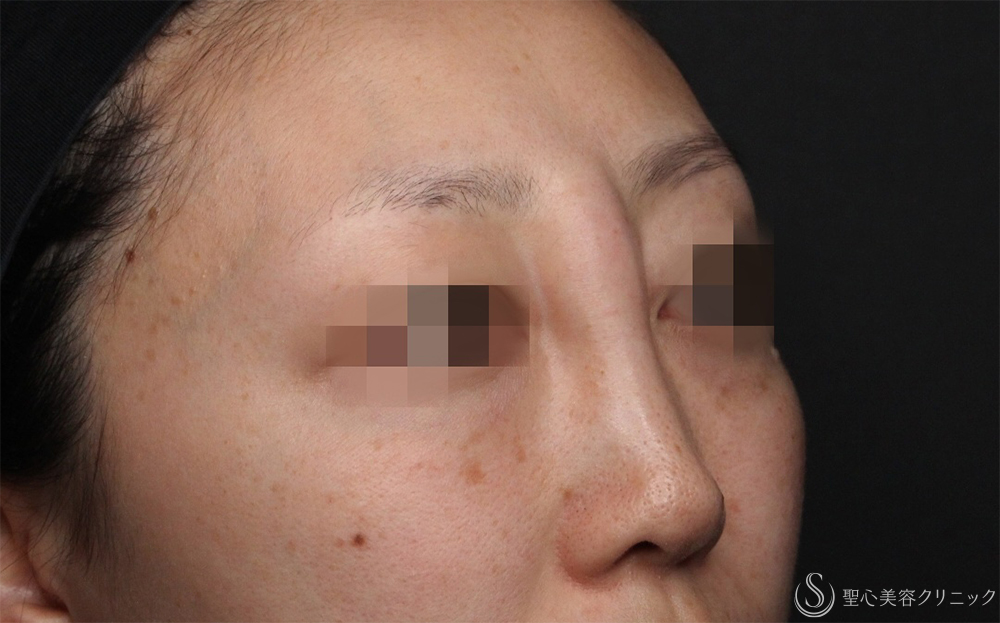 【30代女性・不自然な鼻根修正】鼻アクアミド除去（1ヶ月後） Before 