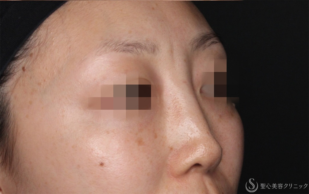 【30代女性・不自然な鼻根修正】鼻アクアミド除去（1ヶ月後） After 