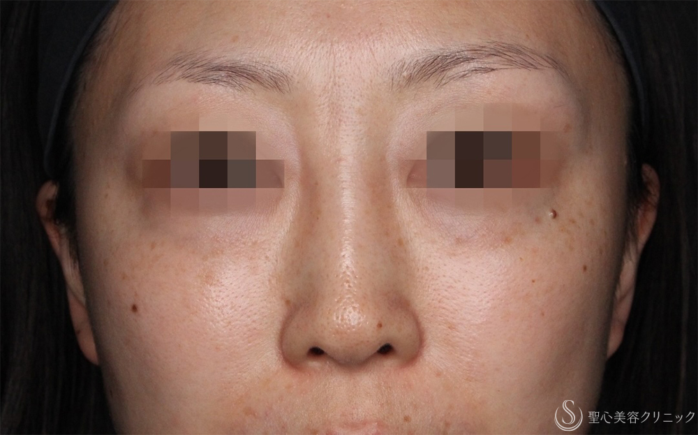 【30代女性・不自然な鼻根修正】鼻アクアミド除去（1ヶ月後） After 