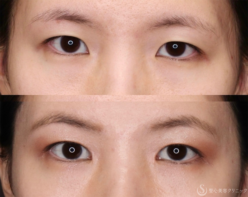 【20代女性・自然な変化で悩みを解消】 目頭切開/目上切開（1ヶ月後） After 