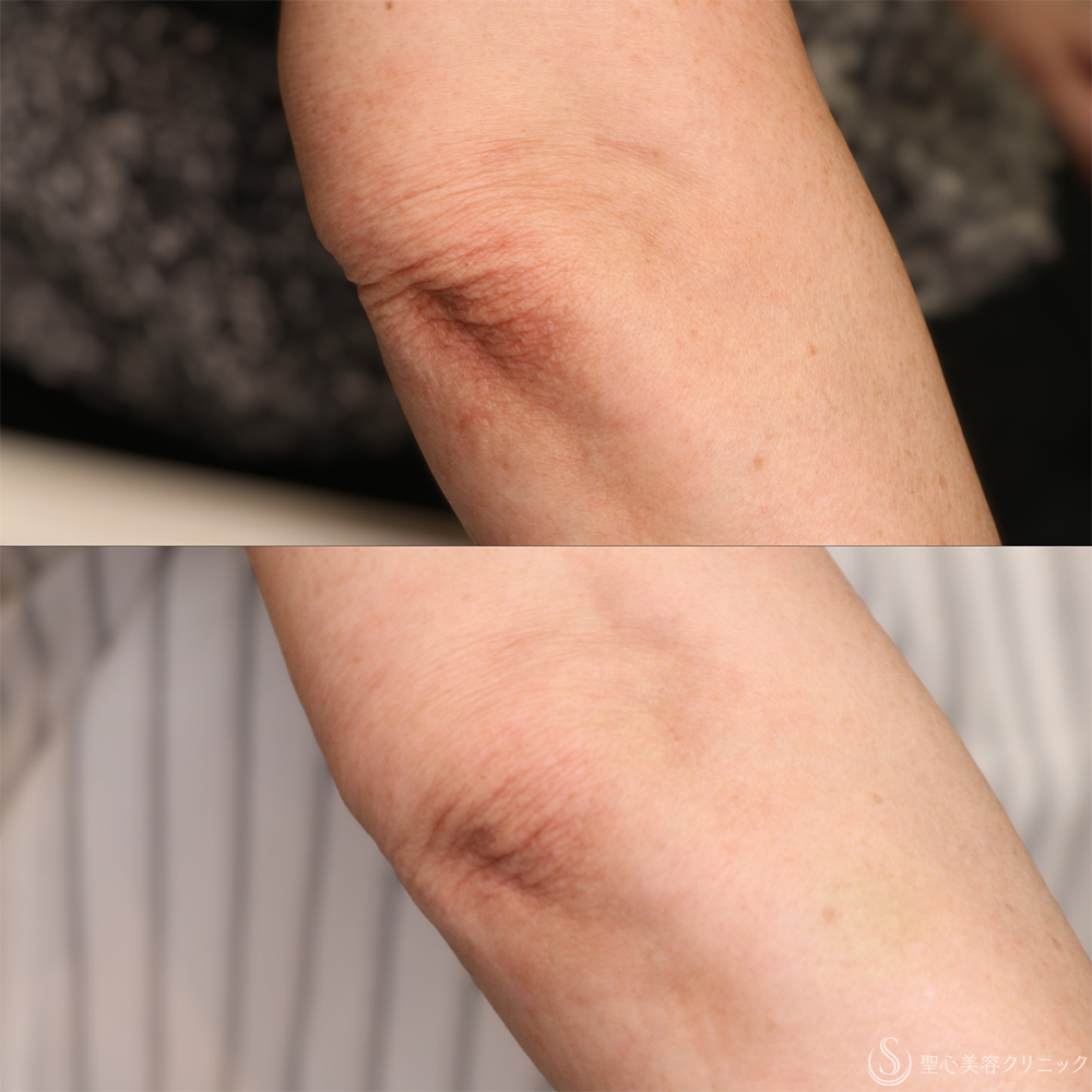 【50代女性・肘を注射で若返り】プレミアムPRP皮膚再生療法（肘/9ヶ月後） After 名古屋・アンチエイジング
