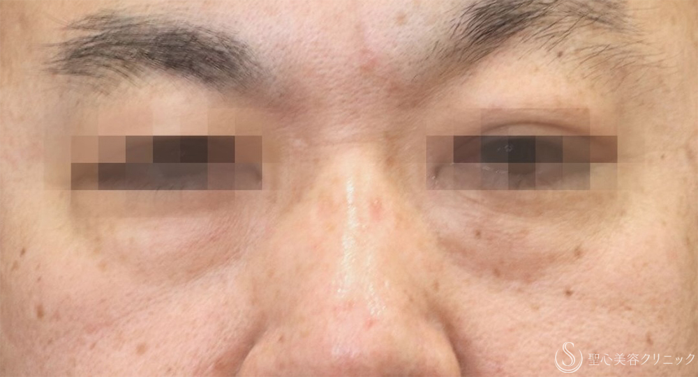 【40代男性・目の下の弛み取り】下眼瞼除皺術＋脂肪除去＋プレミアムPRP皮膚再生療法（3ヶ月後）    　 Before 