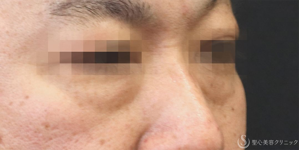 【40代男性・目の下の弛み取り】下眼瞼除皺術＋脂肪除去＋プレミアムPRP皮膚再生療法（3ヶ月後）    　 Before 