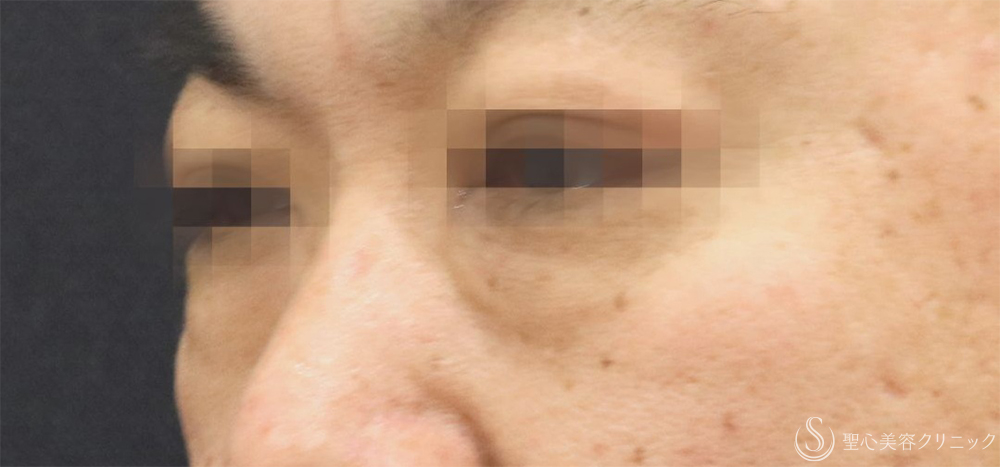 【40代男性・目の下の弛み取り】下眼瞼除皺術＋脂肪除去＋プレミアムPRP皮膚再生療法（3ヶ月後）    　 Before 