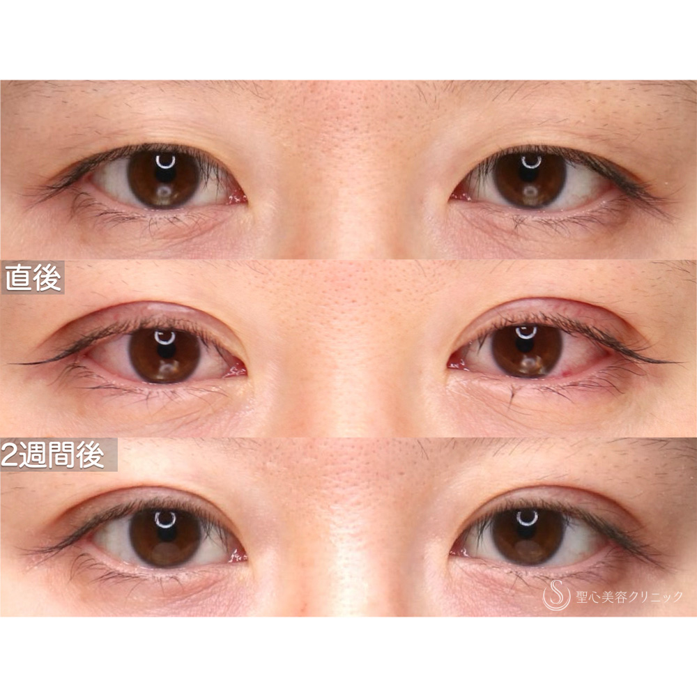 【20代女性・自然なバランスで仕上げる】二重術（埋没法）：マイクロメソッド+α（2週間後） After 