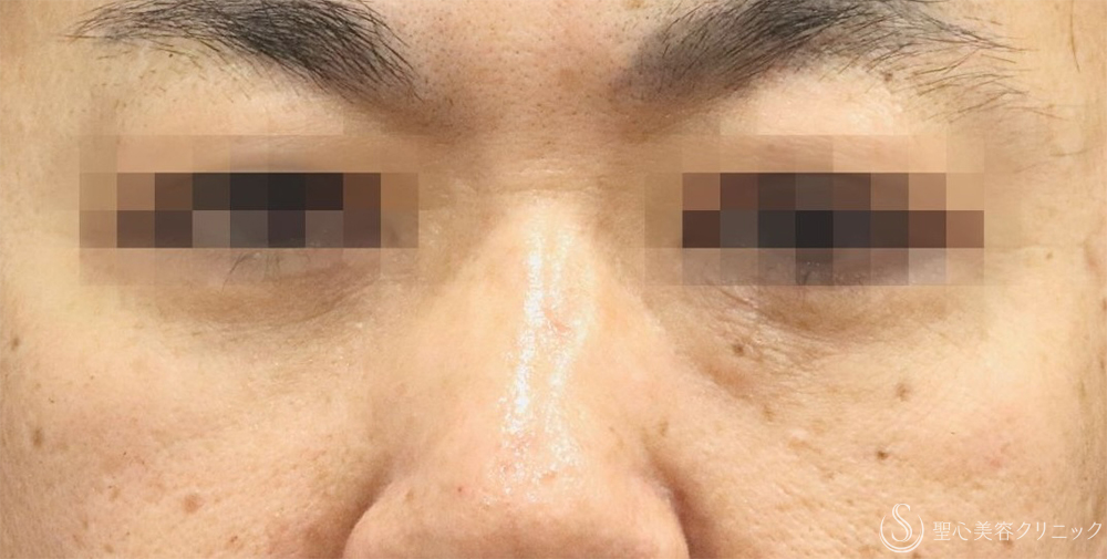【40代男性・目の下の弛み取り】下眼瞼除皺術＋脂肪除去＋プレミアムPRP皮膚再生療法（3ヶ月後）    　 After 