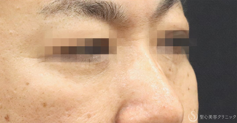 【40代男性・目の下の弛み取り】下眼瞼除皺術＋脂肪除去＋プレミアムPRP皮膚再生療法（3ヶ月後）    　 After 