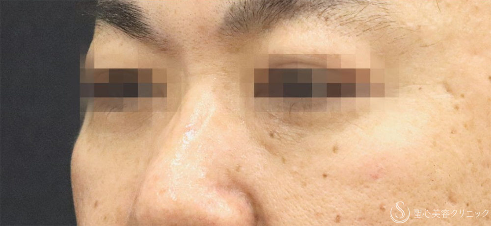 【40代男性・目の下の弛み取り】下眼瞼除皺術＋脂肪除去＋プレミアムPRP皮膚再生療法（3ヶ月後）    　 After 