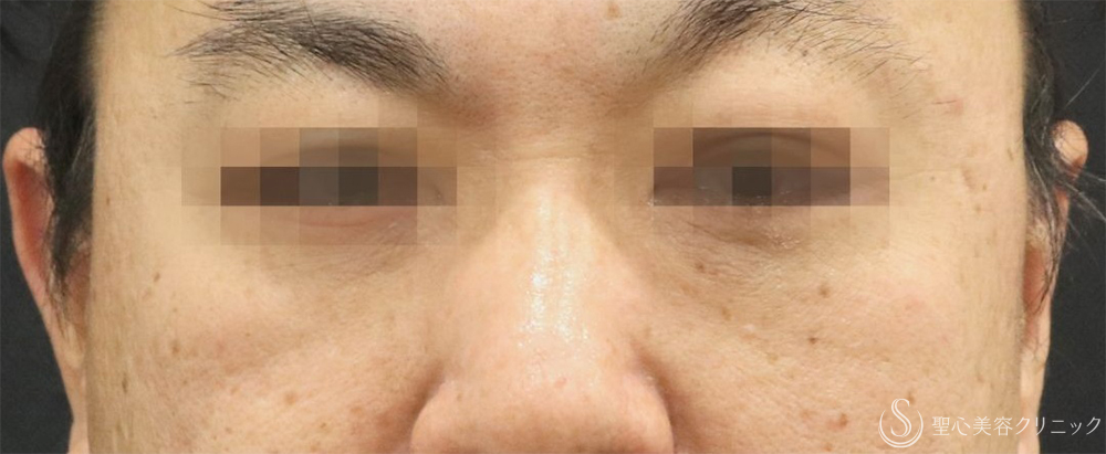 【40代男性・目の下の弛み取り】下眼瞼除皺術＋脂肪除去＋プレミアムPRP皮膚再生療法（3ヶ月後）    　 After 