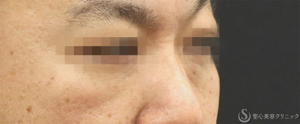 【40代男性・目の下の弛み取り】下眼瞼除皺術＋脂肪除去＋プレミアムPRP皮膚再生療法（3ヶ月後）    　 After 