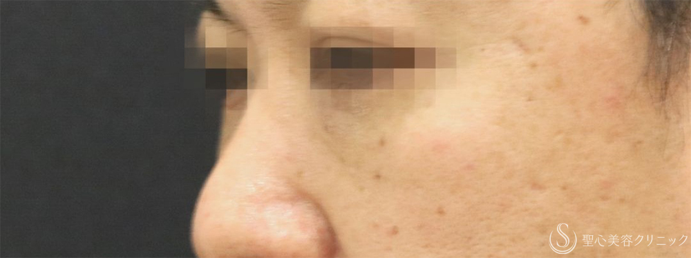 【40代男性・目の下の弛み取り】下眼瞼除皺術＋脂肪除去＋プレミアムPRP皮膚再生療法（3ヶ月後）    　 After 