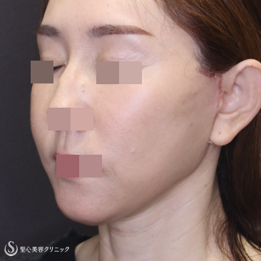 【50代女性・糸リフトを卒業して切開リフトで若返り】フェイスリフト＋頬脂肪吸引（術後1ヶ月） After 