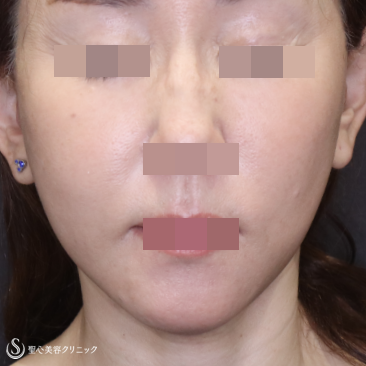 【50代女性・糸リフトを卒業して切開リフトで若返り】フェイスリフト＋頬脂肪吸引（術後1ヶ月） After 