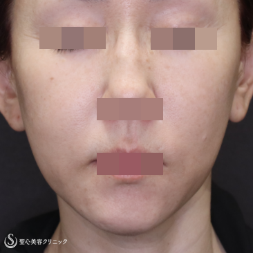 【50代女性・糸リフトを卒業して切開リフトで若返り】フェイスリフト＋頬脂肪吸引（術後1ヶ月） Before 