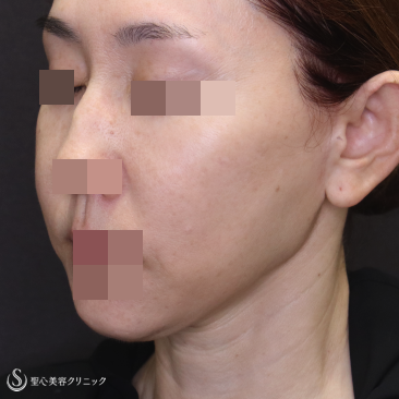 【50代女性・糸リフトを卒業して切開リフトで若返り】フェイスリフト＋頬脂肪吸引（術後1ヶ月） Before 