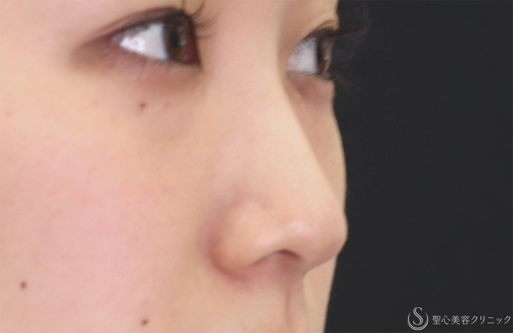 【20代女性・すっきりとした鼻筋に】鼻尖縮小+鼻尖形成（耳介軟骨移植）+G-Mesh（Gメッシュ）3本（10日後） Before 