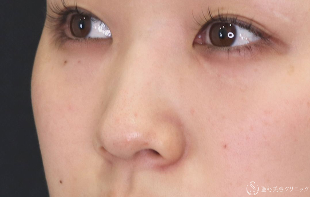 【20代女性・すっきりとした鼻筋に】鼻尖縮小+鼻尖形成（耳介軟骨移植）+G-Mesh（Gメッシュ）3本（10日後） Before 