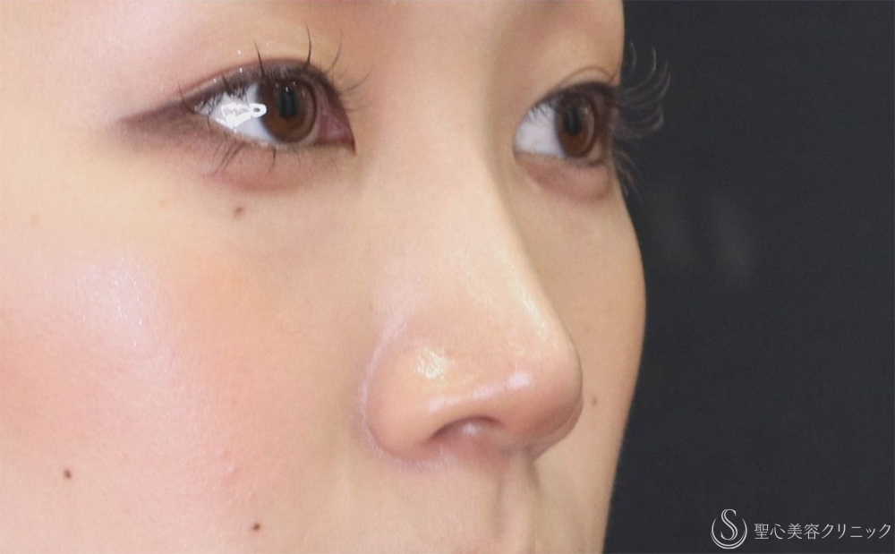【20代女性・すっきりとした鼻筋に】鼻尖縮小+鼻尖形成（耳介軟骨移植）+G-Mesh（Gメッシュ）3本（10日後） After 