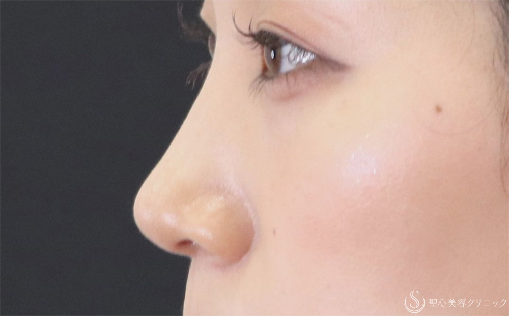 【20代女性・すっきりとした鼻筋に】鼻尖縮小+鼻尖形成（耳介軟骨移植）+G-Mesh（Gメッシュ）3本（10日後） After 