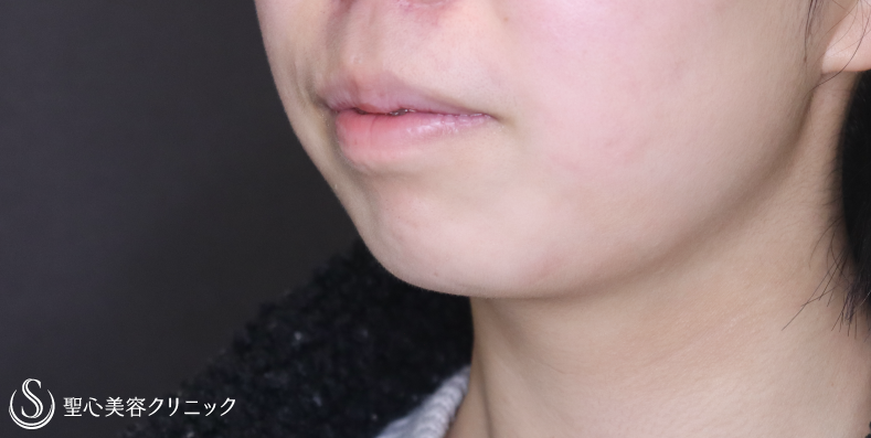 【20代女性・Eラインを整える】顎プロテーゼ挿入術（術後1ヶ月） Before 