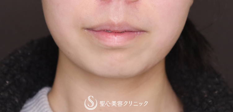 【20代女性・Eラインを整える】顎プロテーゼ挿入術（術後1ヶ月） Before 