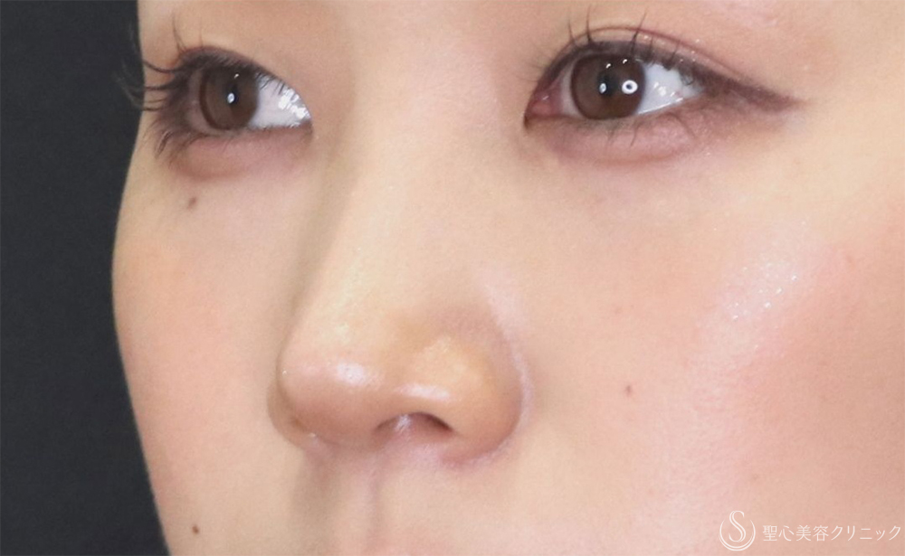 【20代女性・すっきりとした鼻筋に】鼻尖縮小+鼻尖形成（耳介軟骨移植）+G-Mesh（Gメッシュ）3本（10日後） After 