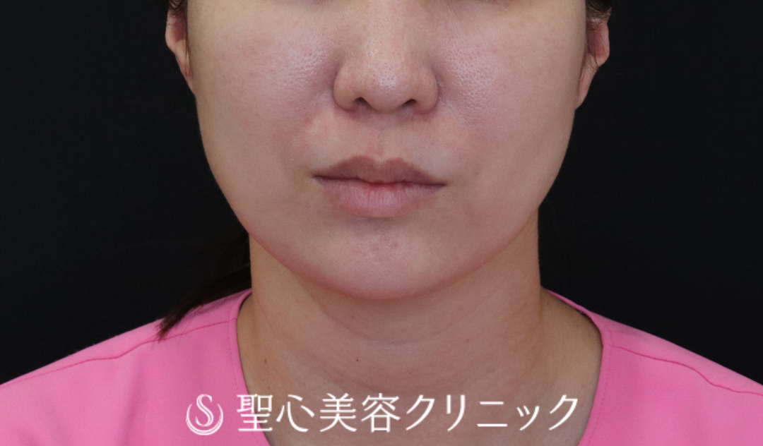 【40代女性・輪郭をすっきりと】ウルトラセル[zíː]（直後～1ヶ月後） Before 
