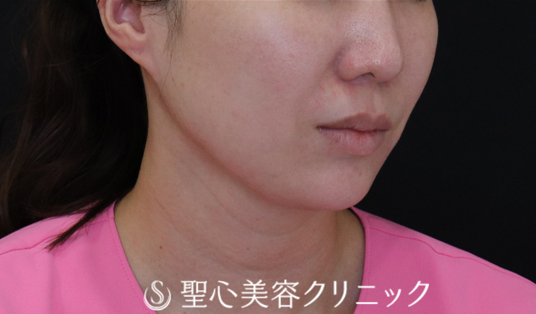 【40代女性・輪郭をすっきりと】ウルトラセル[zíː]（直後～1ヶ月後） Before 