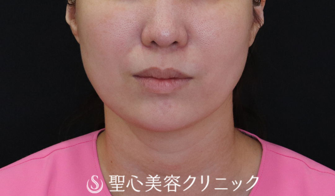 【40代女性・輪郭をすっきりと】ウルトラセル[zíː]（直後～1ヶ月後） After 