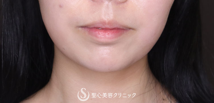 【20代女性・Eラインを整える】顎プロテーゼ挿入術（術後1ヶ月） After 