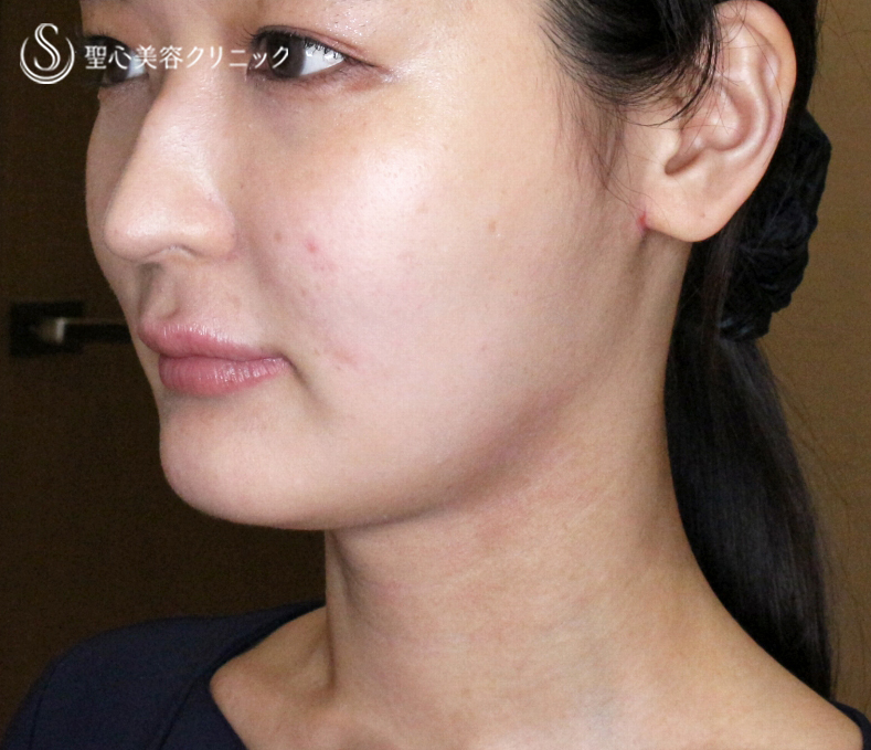 【20代女性・画期的な最新リフト＆小顔マシン】ワンダーフェイスプロ（1回処置直後） Before 
