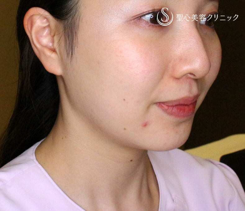 【20代女性・画期的な最新リフト＆小顔マシン】ワンダーフェイスプロ（2回処置後） Before 