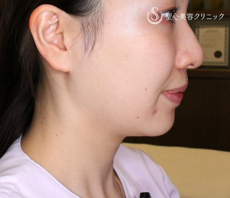 【20代女性・画期的な最新リフト＆小顔マシン】ワンダーフェイスプロ（2回処置後） Before 