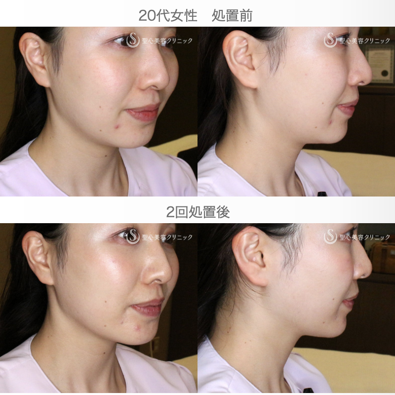 【20代女性・画期的な最新リフト＆小顔マシン】ワンダーフェイスプロ（2回処置後） After 