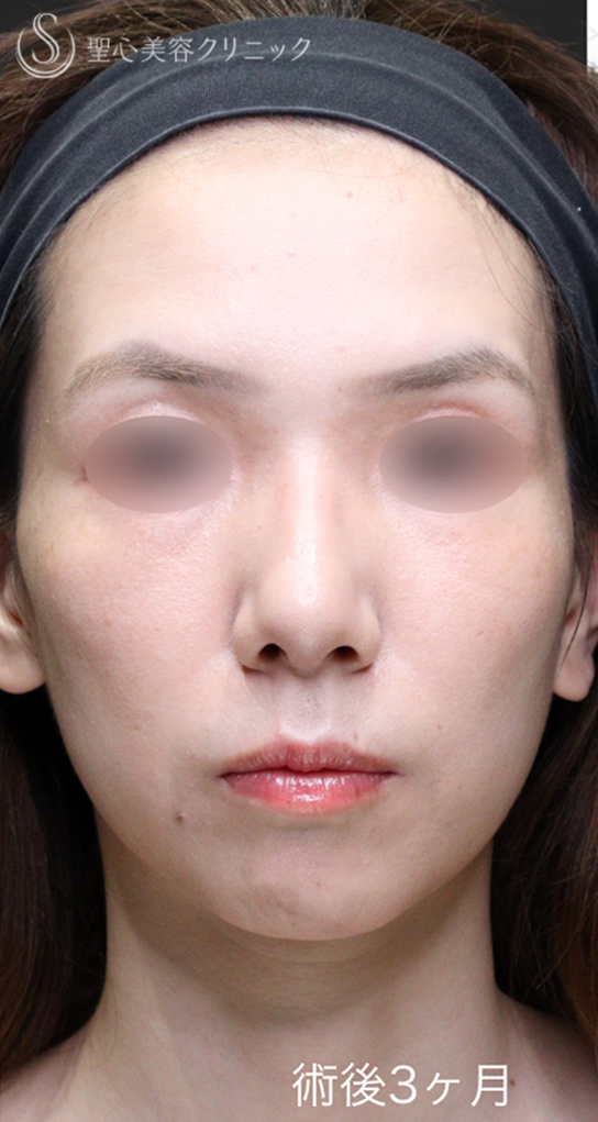 【30代女性・鼻先の丸みを改善】鷲鼻修正＋鼻尖縮小＋鼻尖形成（3ヶ月後） After 