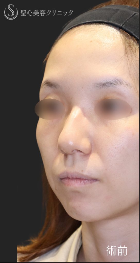 【30代女性・鼻先の丸みを改善】鷲鼻修正＋鼻尖縮小＋鼻尖形成（3ヶ月後） Before 
