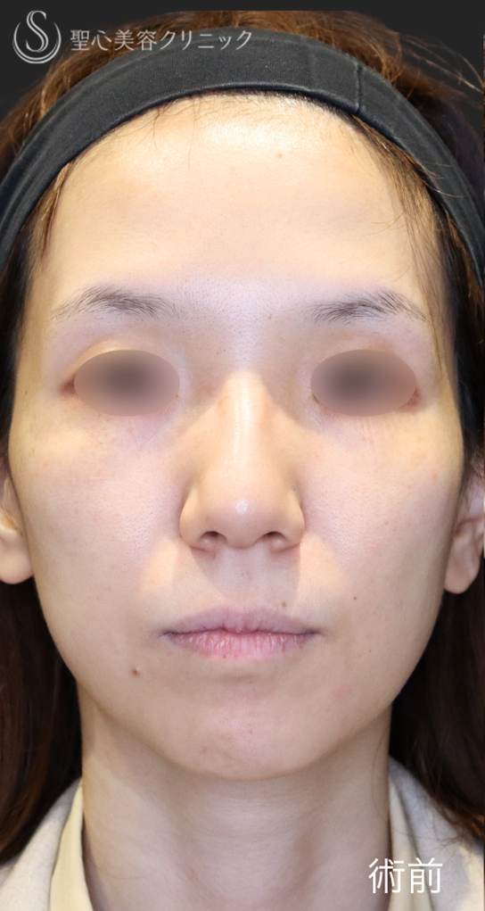 【30代女性・鼻先の丸みを改善】鷲鼻修正＋鼻尖縮小＋鼻尖形成（3ヶ月後） Before 