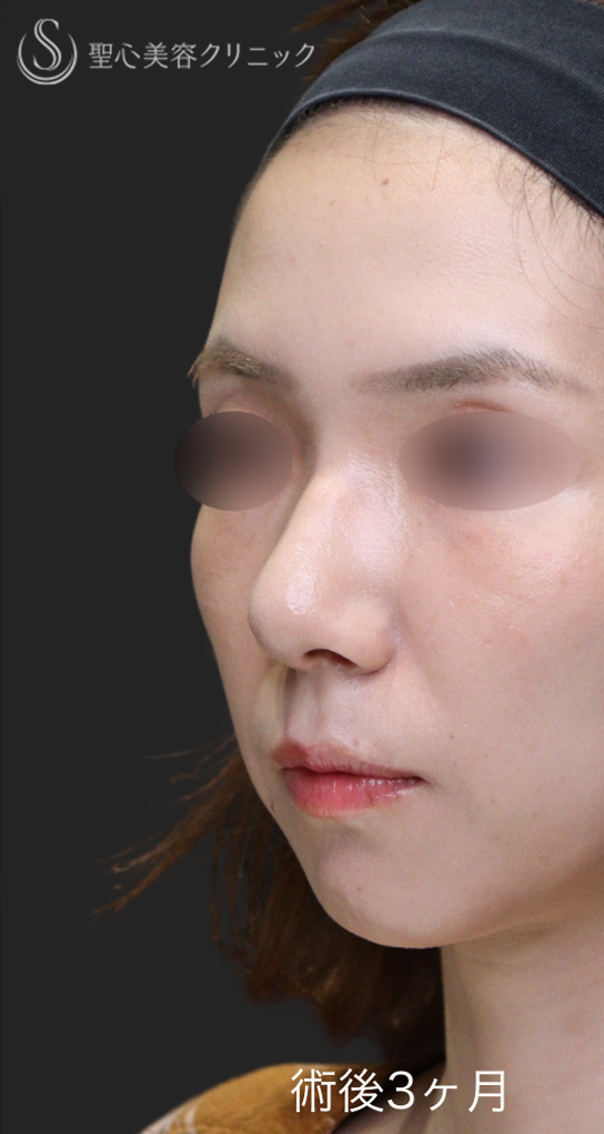【30代女性・鼻先の丸みを改善】鷲鼻修正＋鼻尖縮小＋鼻尖形成（3ヶ月後） After 